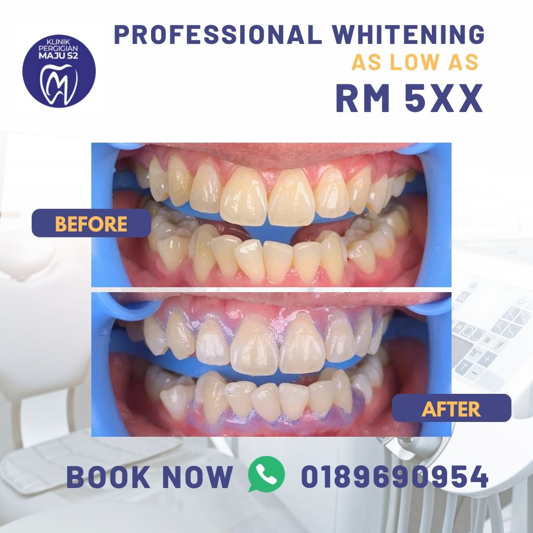 whitening gigi